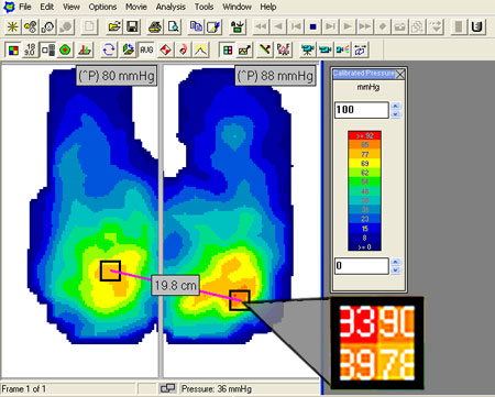 With CONFORMat software easily identify high pressure areas (in red) and view peak pressure (^P)