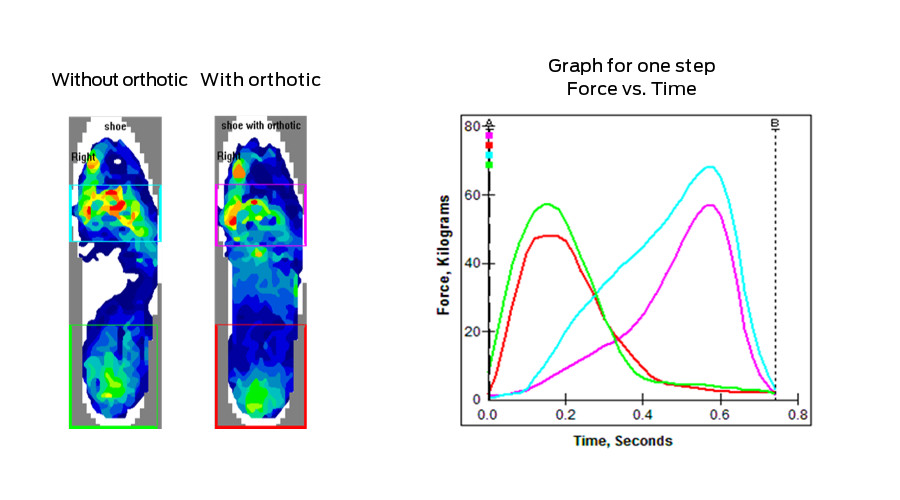 Figure 5 - Force versus time curves and pressure profiles for the same right foot before and after treatment, except the foot is broken down into a forefoot and heel segmentation. Differences in both heel and forefoot force/time curves are now much more apparent