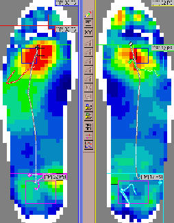 F-Scan Pressure Profiles After the First Ray Cutout