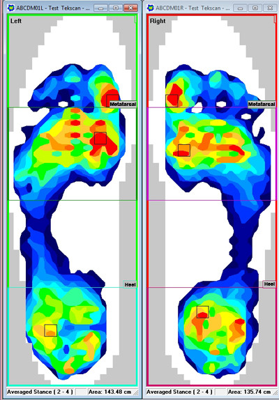 The ability to segment the foot for detailed analysis is one difference from a force plate.