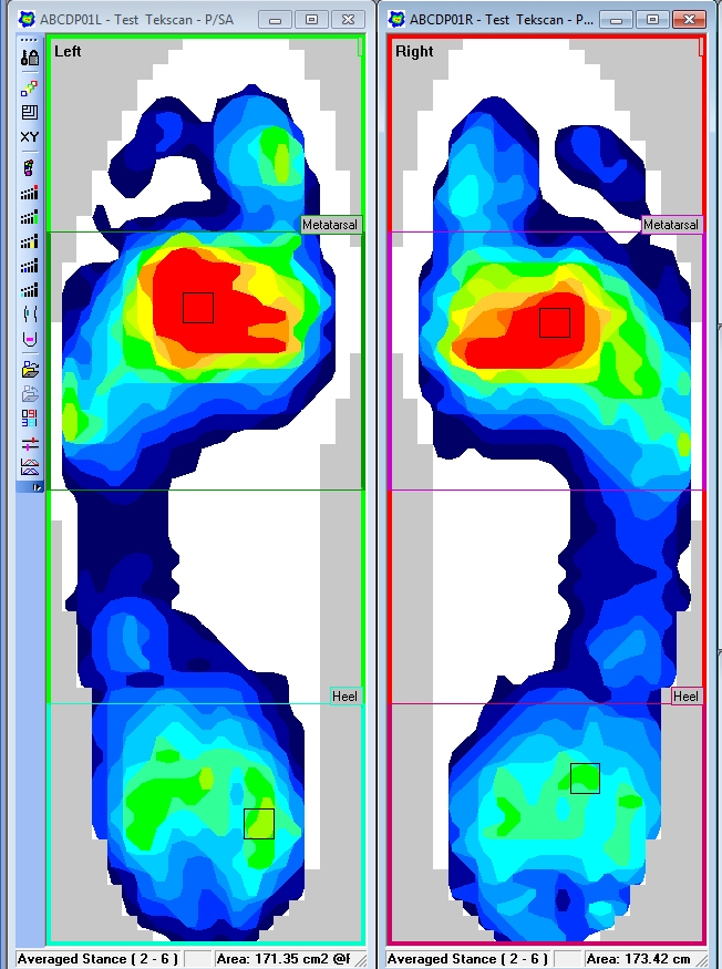 The ability to segment the foot for detailed analysis is one difference from a force plate.