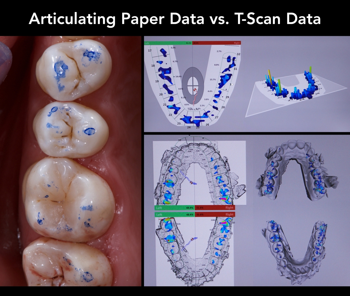 Articulating Paper Data vs. T-Scan Data