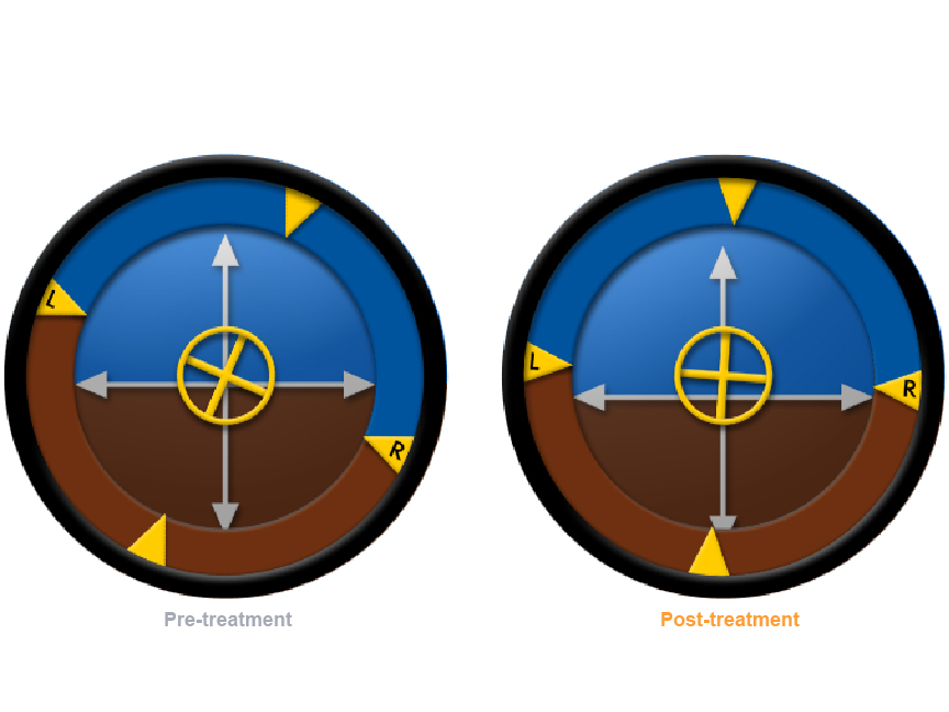 The Balance Compass in SportsAT software was used during the rehabilitation process.