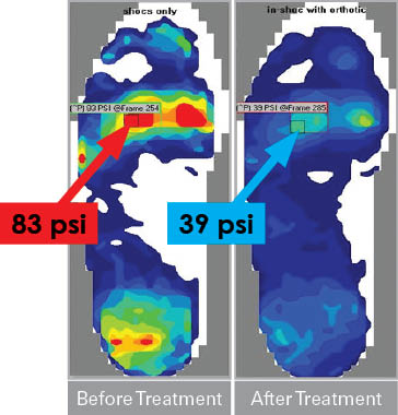 Wound Care In Shoe