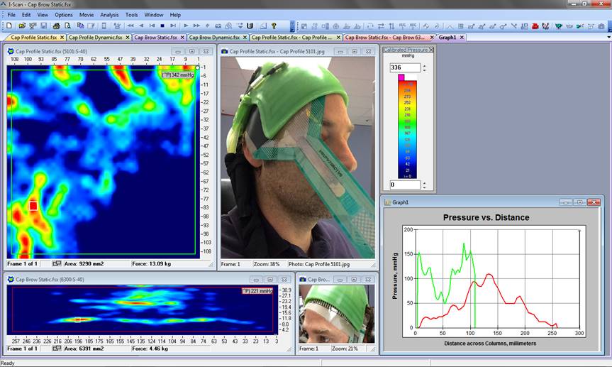 2D pressure display during comfort comparative testing with I-Scan sensors positioned on different positions of the patient’s scalp.