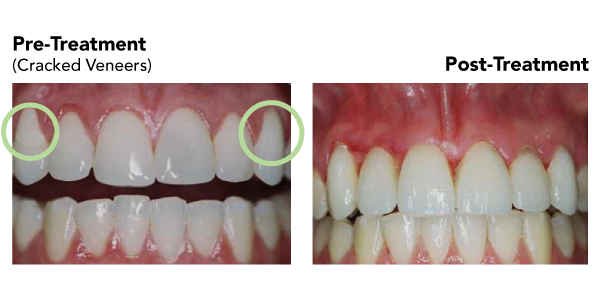 cracked veneers