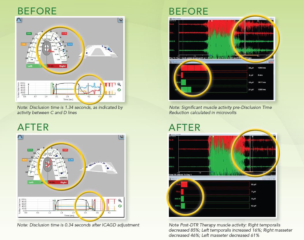 DTR Therapy software images: Before and After treatment