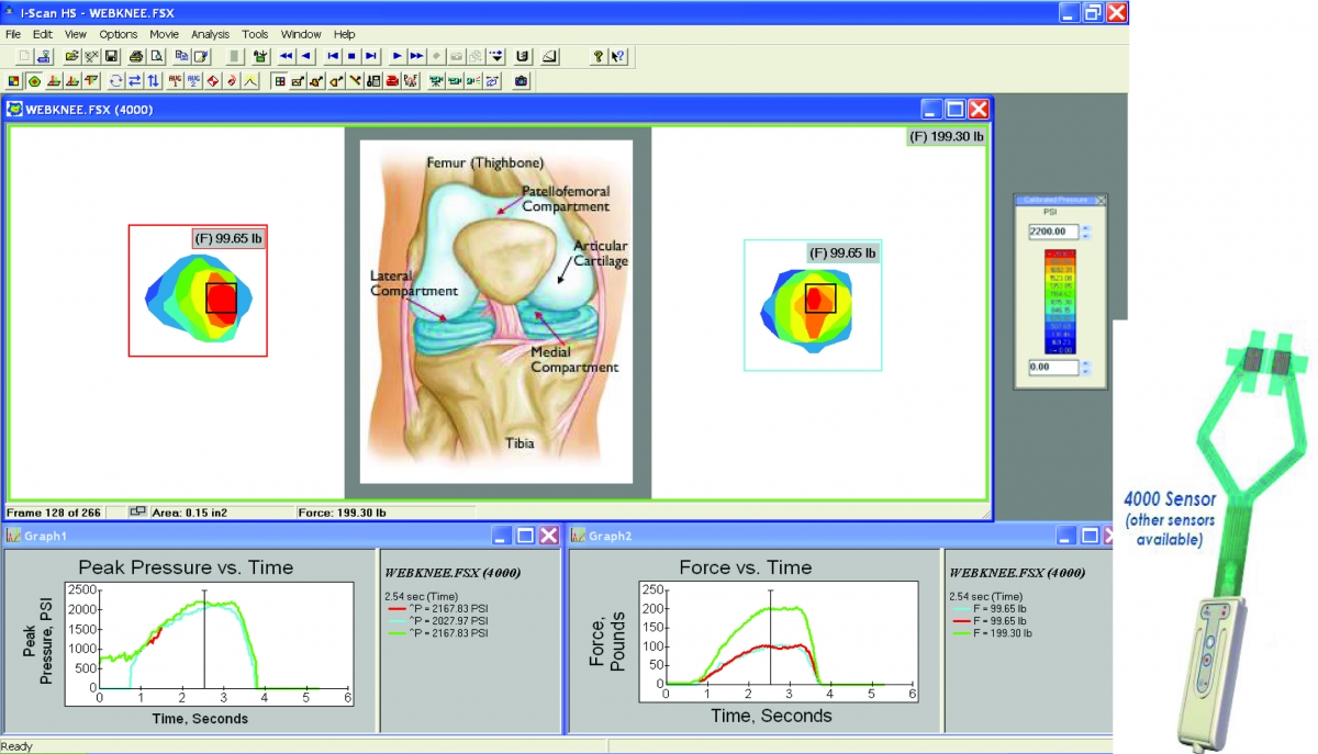 Human Knee Joint Implant