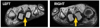 T1 weighted short axis foot MRI