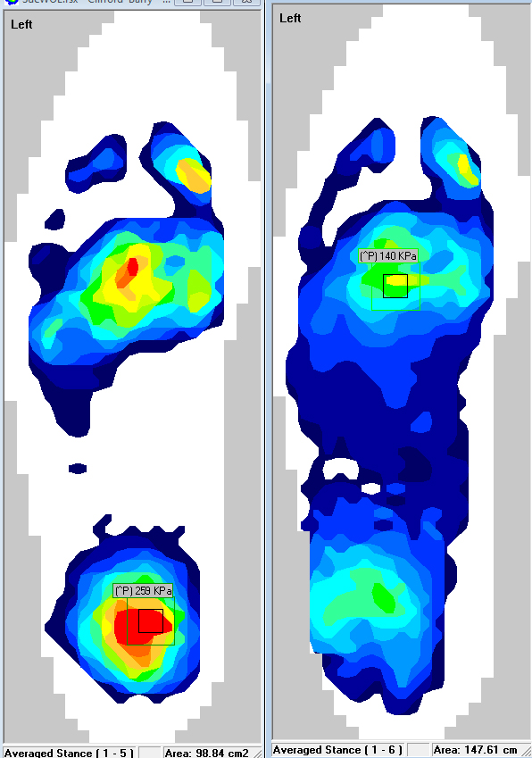 Insights from F-Scan Software: Notice that the peak pressure from the image on the left (pre-orthotic) have been significantly decreased to the image on the right (with the orthotic).