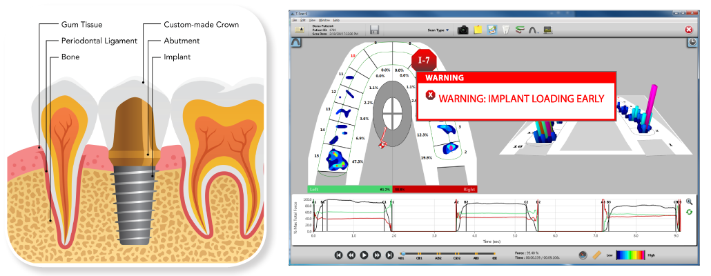 The &quot;Implant Loading Alert&quot; from T-Scan Novus provides clear evidence on whether adjustments may be needed.