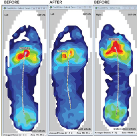 Validating Orthotic Interventions with F-Scan