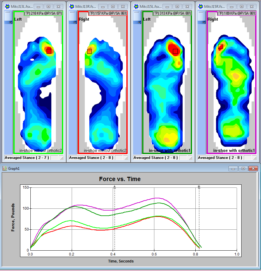 Compare differences between orthotics and various materials with Tekscan's in-shoe analysis system.