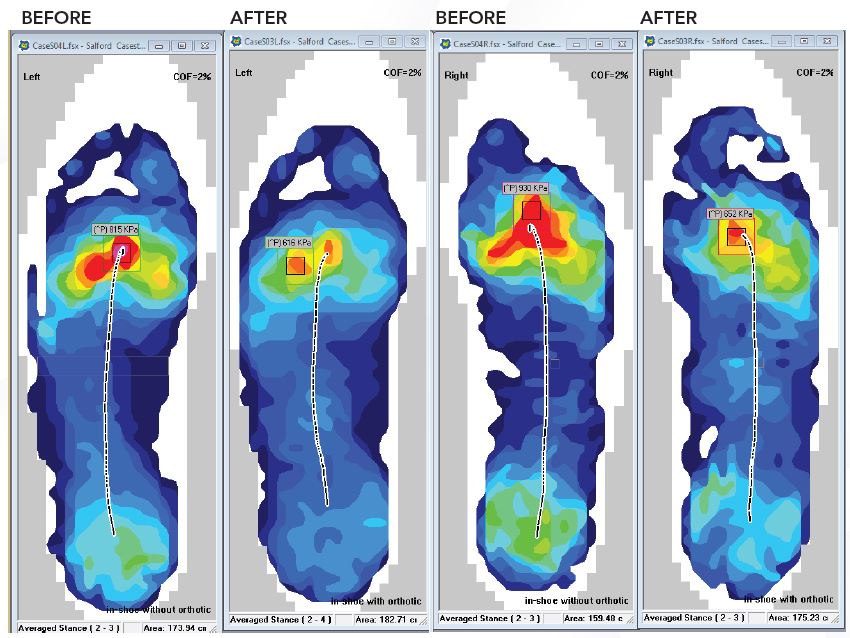 Screenshot displays pressure distribution in a trainer type shoe only &quot;before&quot; with the orthotic device &quot;after.&quot;
