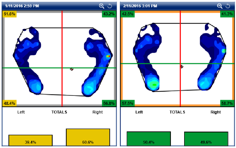 Weight distribution before and after treatment.