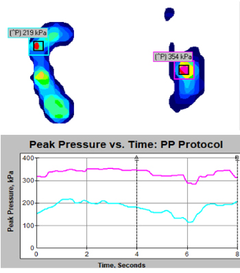 Fig #1: Pressure mat measurement using bilateral loading. Notice the wavering PP; highly unstable.