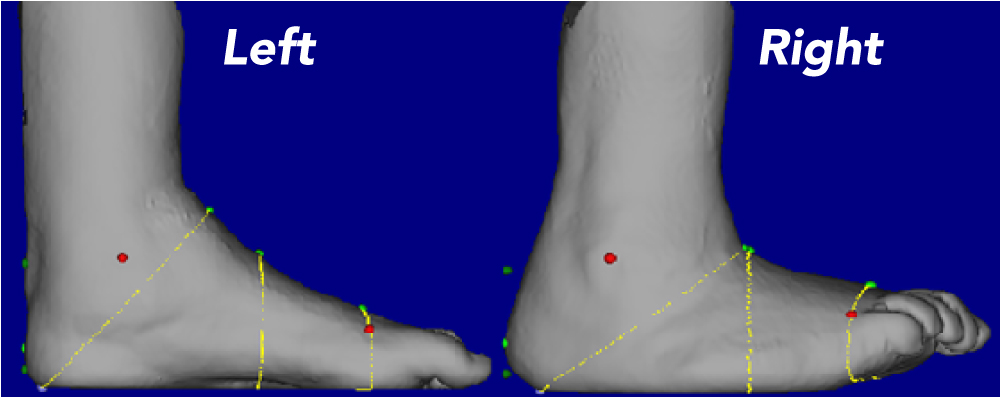 Fig #2: 3D LASER scan of the feet for Last making in a static moment. Visible deformity in the right foot and the inclined ankle, combined with the PP from the Mat is sufficient evidence to support that this patient will fail in a prefab shoe; client has a history of failure in prefabricated footwear.