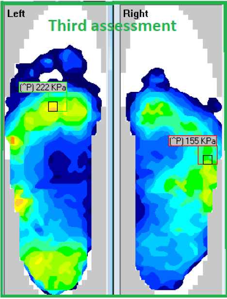 Fig #5: Third F-Scan assessment, and the final outcome for the patient.