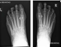 Weight-bearing X-ray (Left) and (Right)