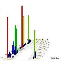 Lateral interferences pre-treatment shown in 3-D view prolong reaching anterior guidance