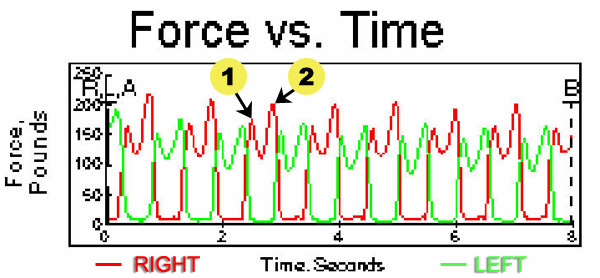 Gait Curve of Asymmetry - Before