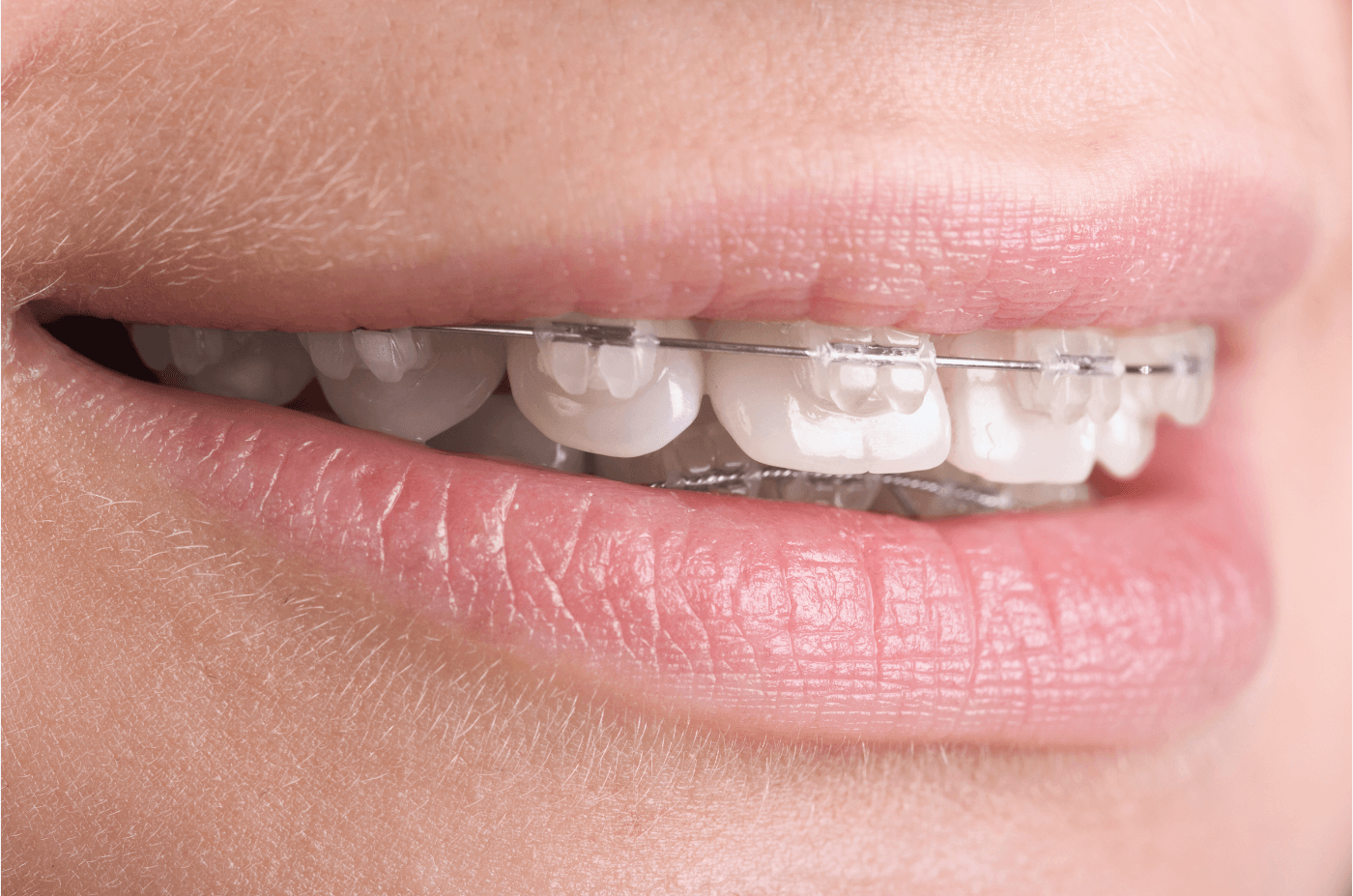 New Study Uses TScan Technology to Reveal Orthodontia’s Impact on the