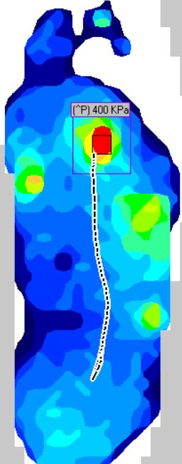 400kPa Foot Pressure Site