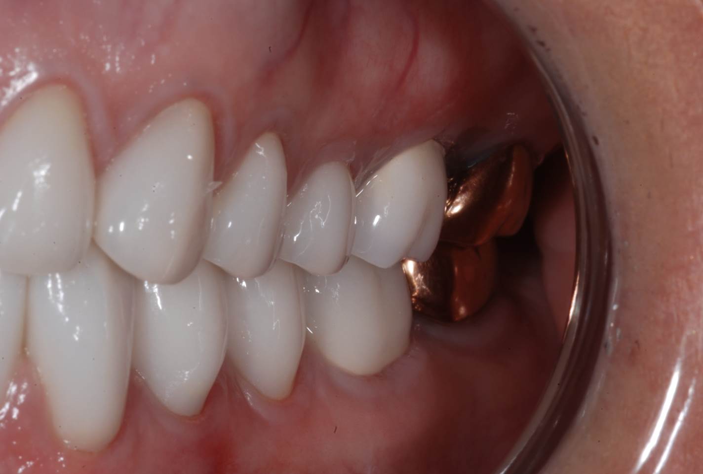 Digital Occlusion for Timing Your Posterior Door Stops inar On