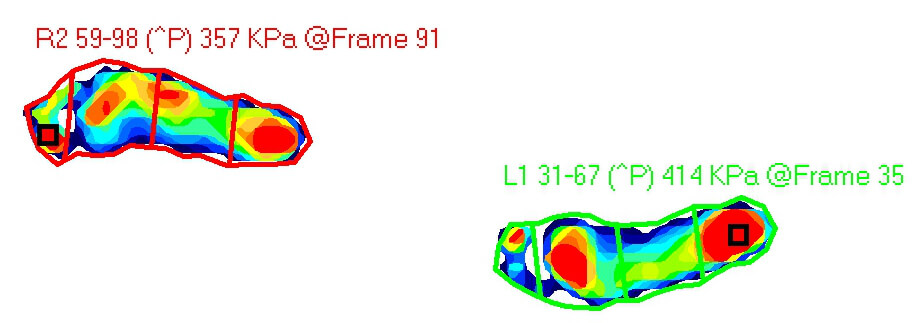 Foot segmentation in gait analysis