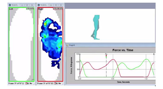 F-Scan & the Gait Cycle