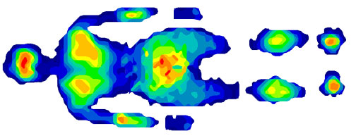 Output of subject laying on a 2-sensor mat configuration (sensor model 5400ND). The high spatial resolution of the sensor allows you to measure and display the high pressure areas (in red) as the subject is laying down.