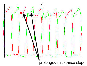 Force vs. Time Graph - Before Orthotics