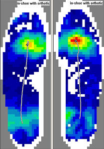 Pressure Profile After Orthotic