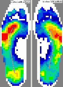 Pressure Profile Before Orthotic