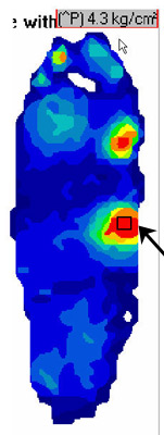 Pressure Profile Before Orthotic