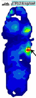 F-Scan - After Orthotic