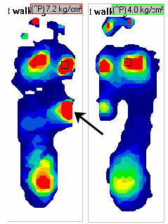 Diabetic Ulcer Before Orthotic