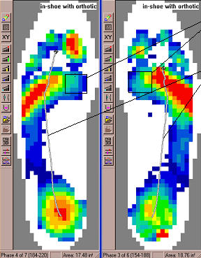 F-Scan Indications of FHL