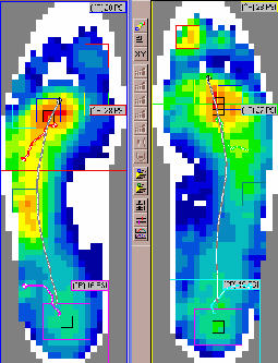 F-Scan of Functional Hallux Limitus