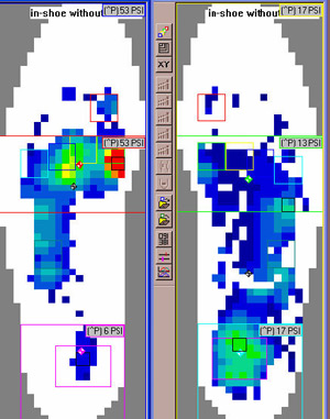 Limb Length Difference Left Side