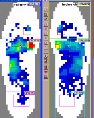 Limb Length After Heel Lift