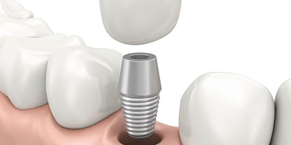 why use t-scan for implant dentistry