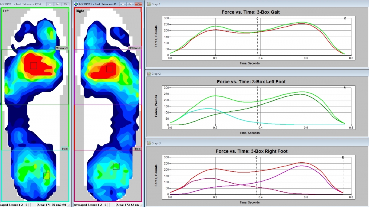 The F-Scan System provides detailed information for a complete gait analysis.