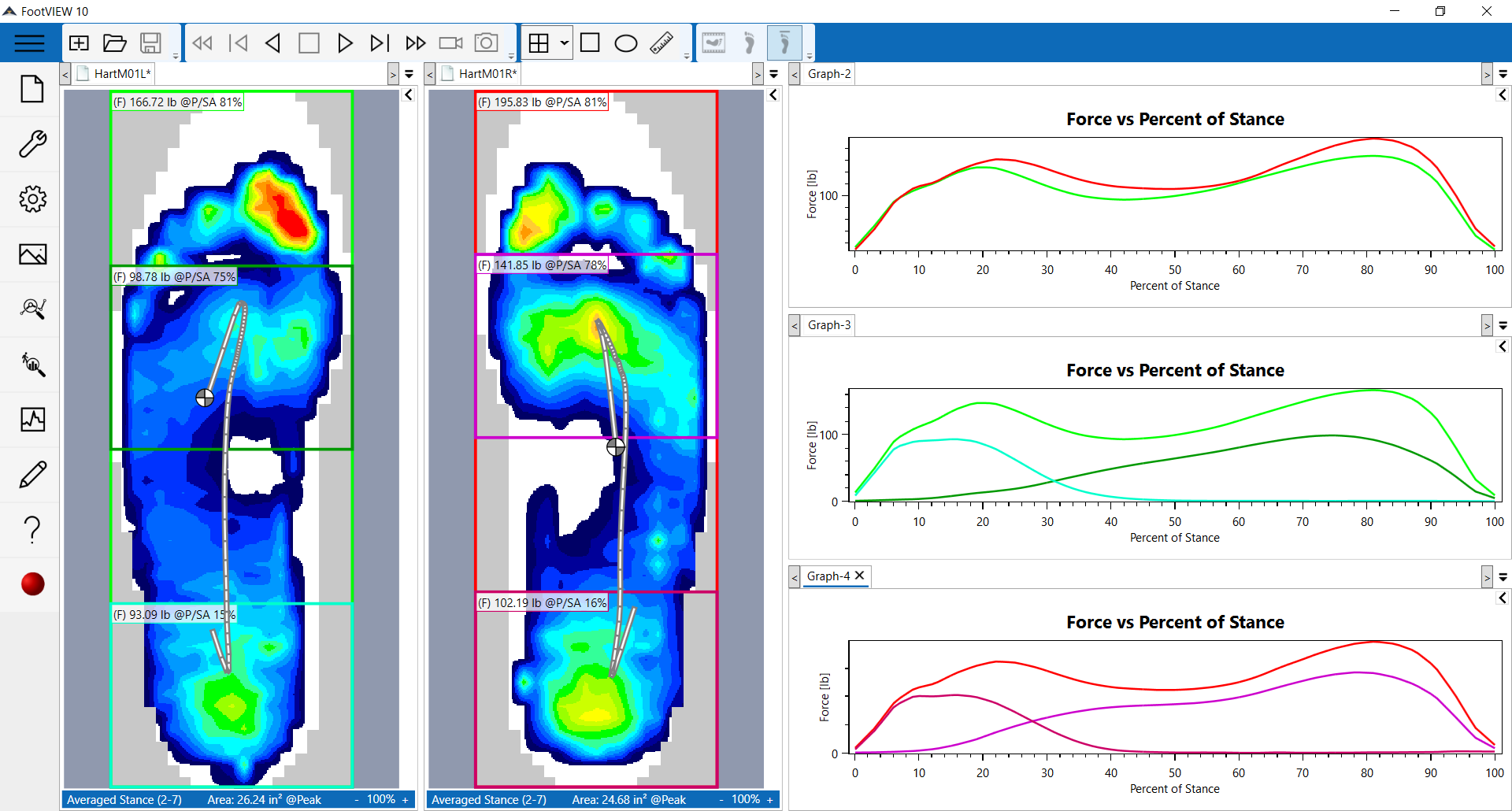 Tekscan software allows you to segment the foot for a more detailed foot function analysis and identifies the area of highest pressure.