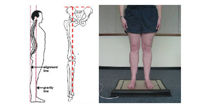 Lower Limb Alignment