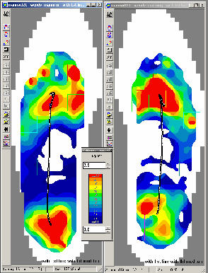 Pressure Profiles with New Orthoses