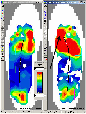 F-Scan Pressure Profile