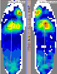 Pressure Profile With Orthtocs