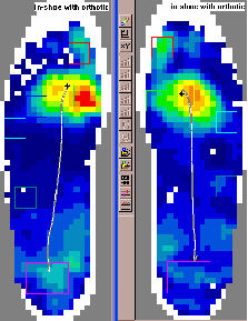 Pressure Profile with Final Orthotics