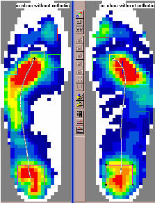 Pressure Profile Before Orthotics